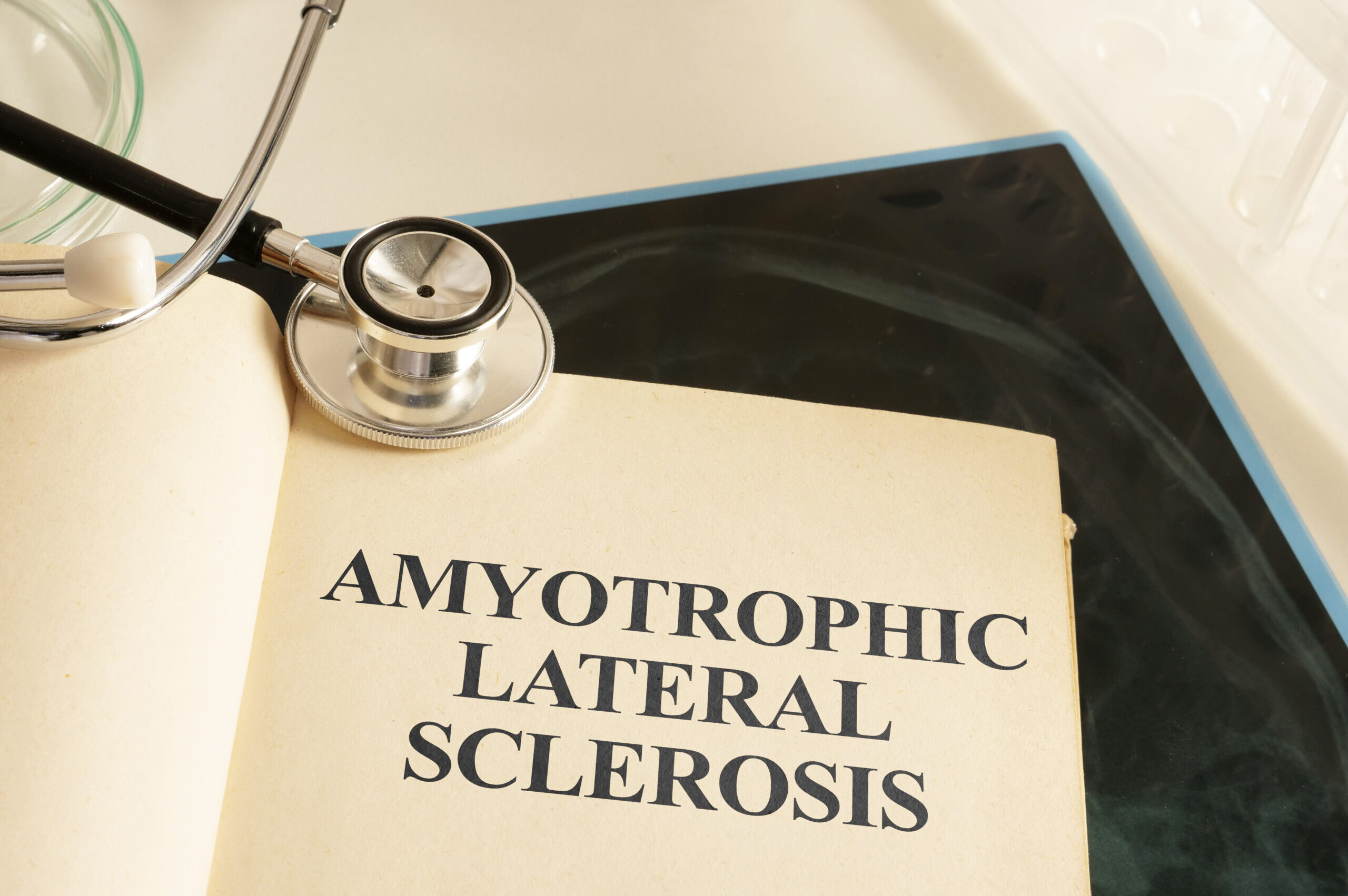 ALS (Amyotrophe Lateralsklerose)